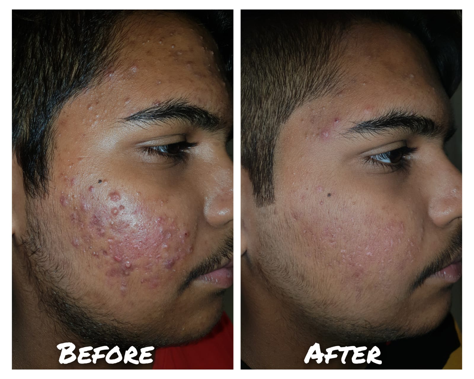 Hair Regrowth Treatment - PRP HAIR Treatment